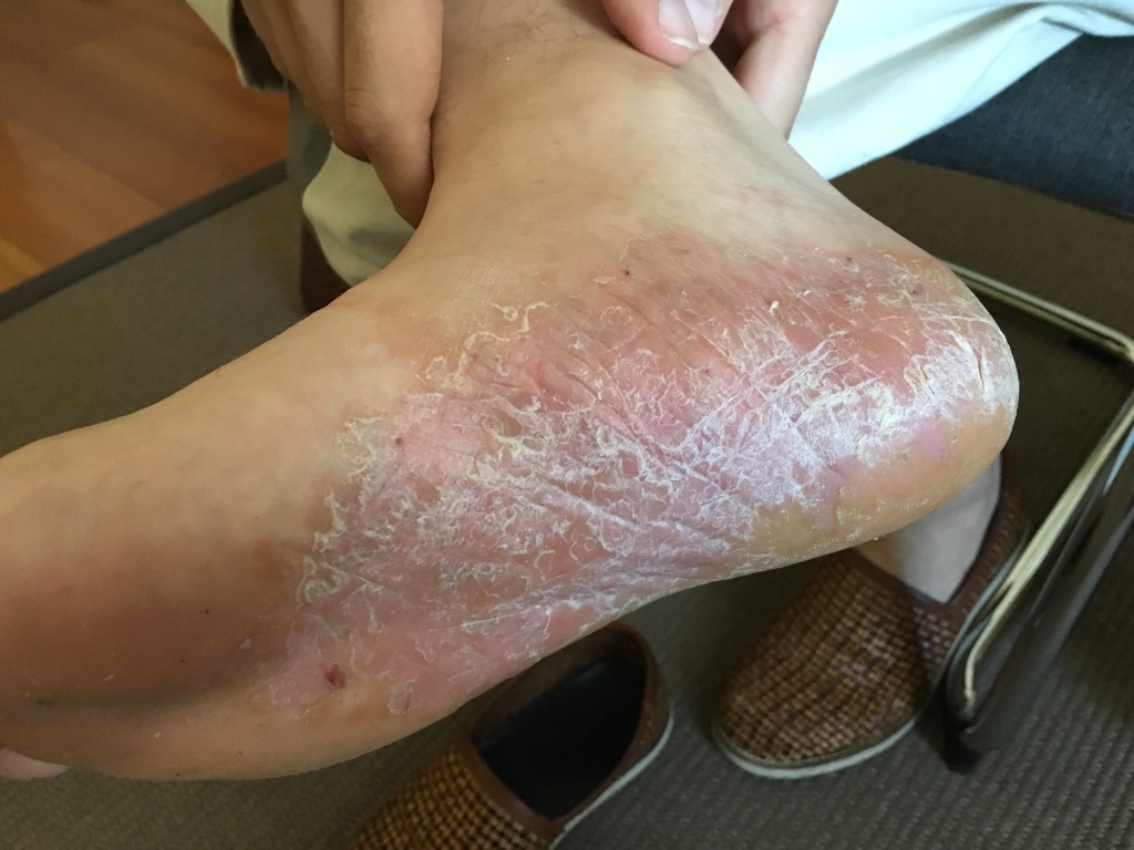 Schalk Pichler Syphilis