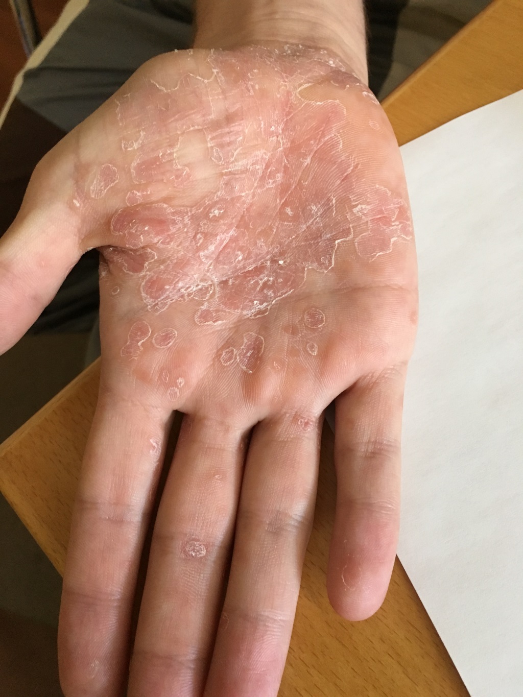 Schalk Pichler Syphilis