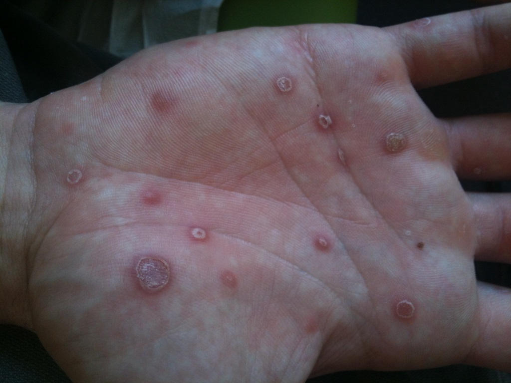 Syphilis Sekundaerstadium Schuppende Rote Flecken Der Handflaechen Kopie Schalk Pichler